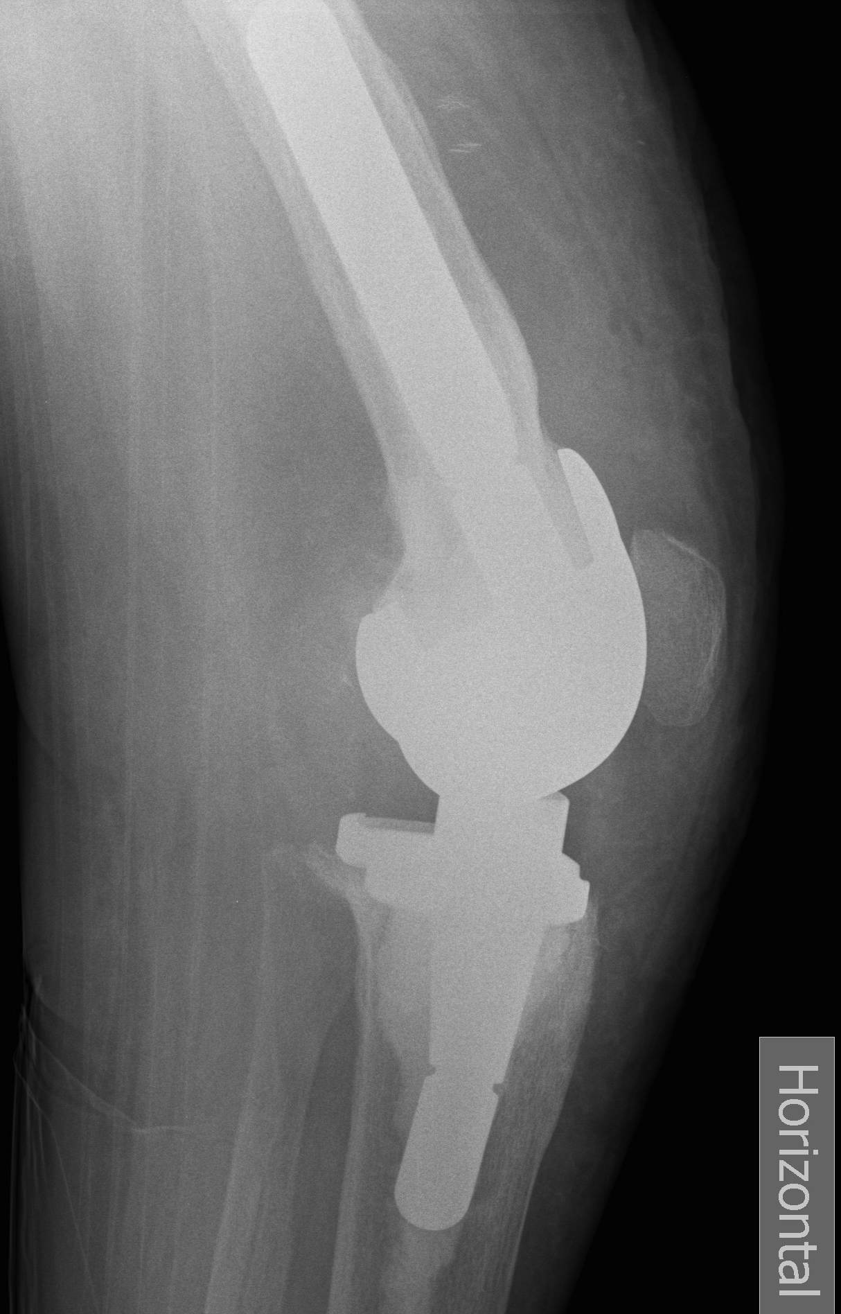 Revision TKR Rotating HInge Lateral